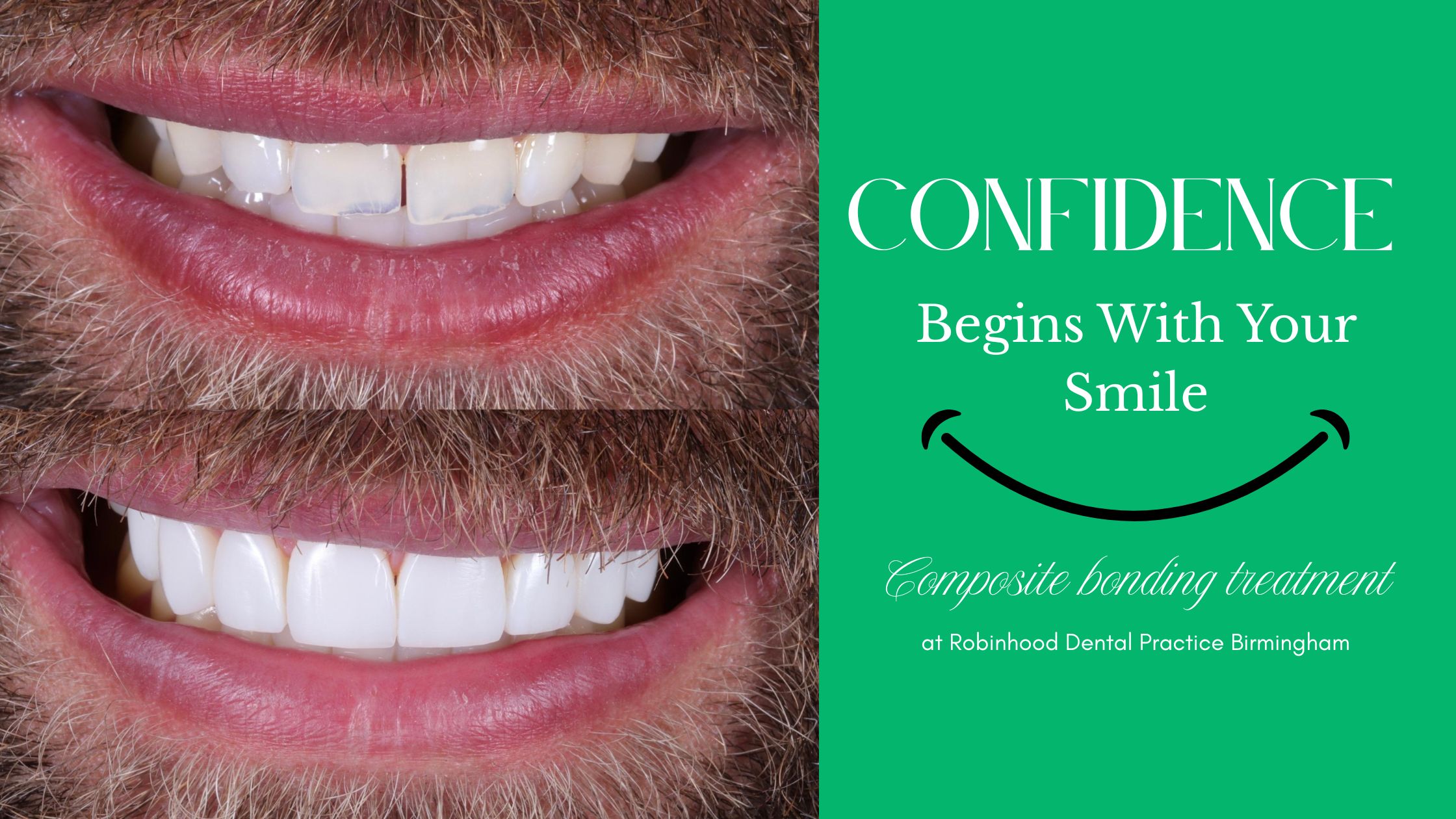 Composite bonding treatment at Robinhood Dental Practice Birmingham