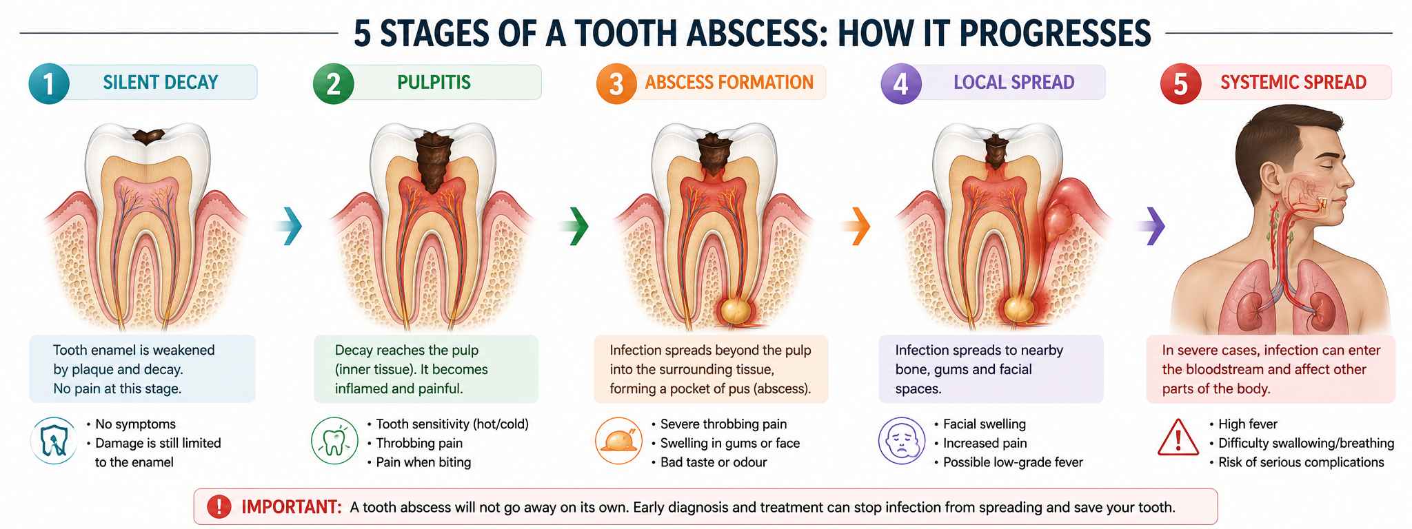 The five stages of tooth abscess progression