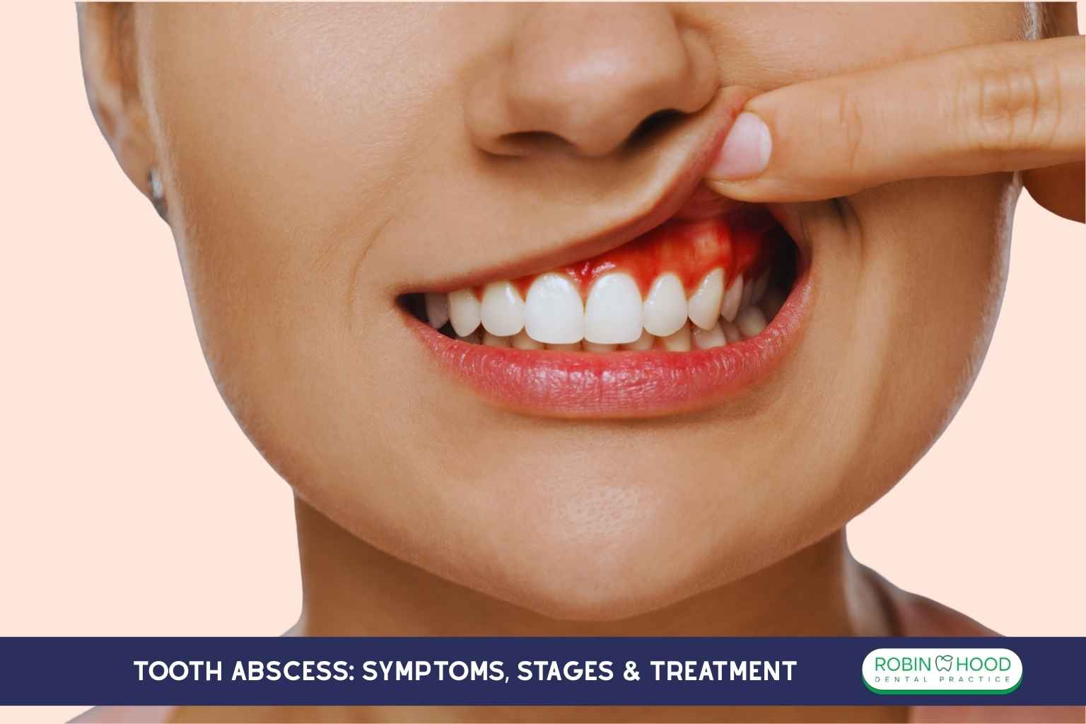 Tooth Abscess: Symptoms, Stages & Treatment