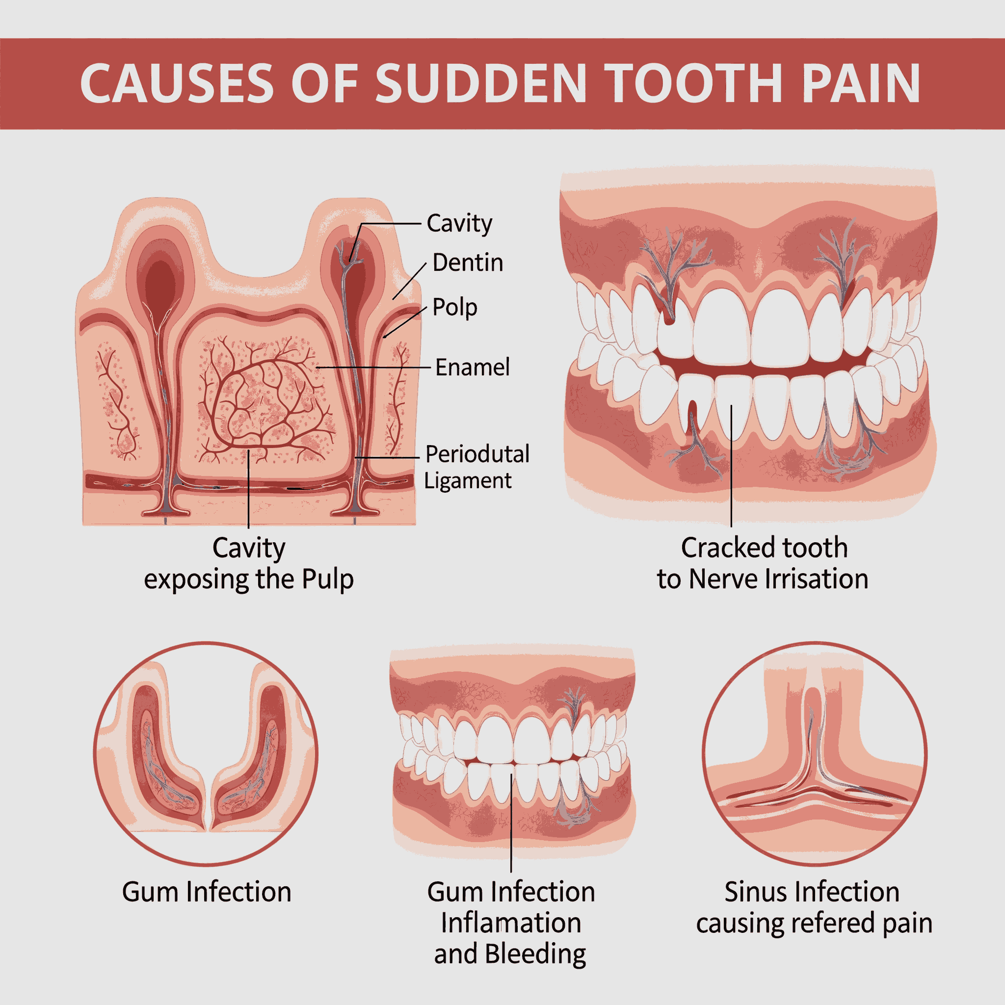 Illustration of a swollen gum with an abscess and pus formation.