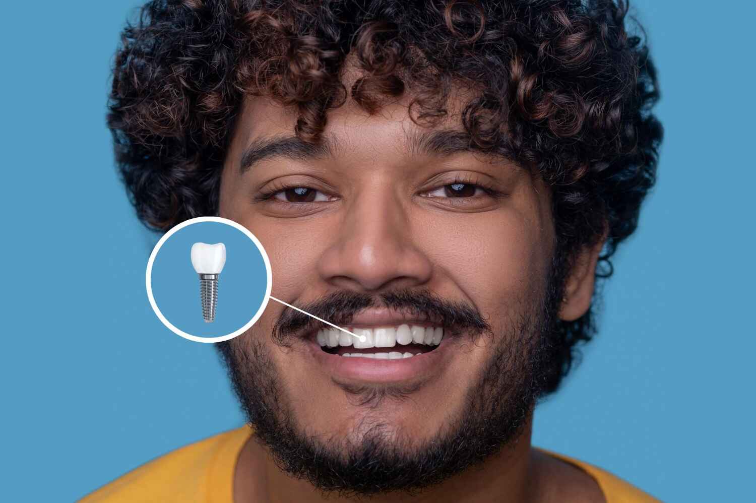 Single Dental Implant Cost Birmingham (2026 Guide) 