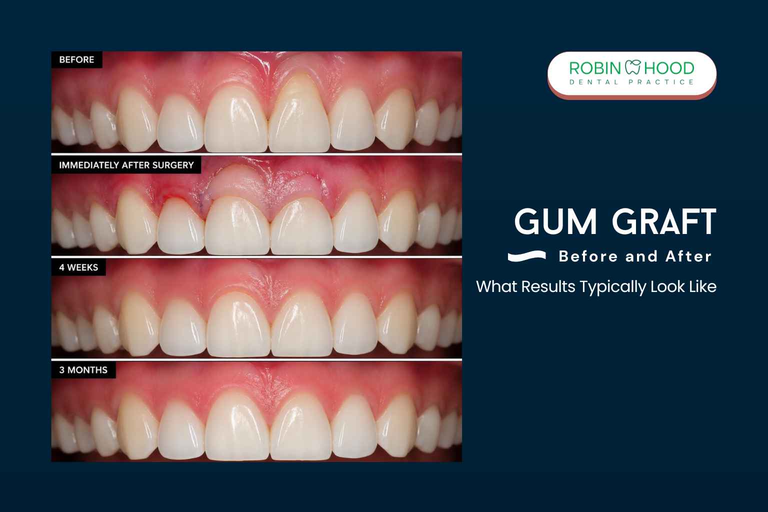 Gum graft before and after showing gum recession and healing progress from immediately after surgery to 4 weeks and 3 months.