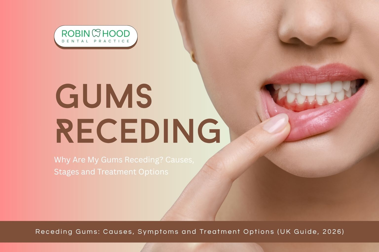 Why Are My Gums Receding? Causes, Stages and Treatment Options