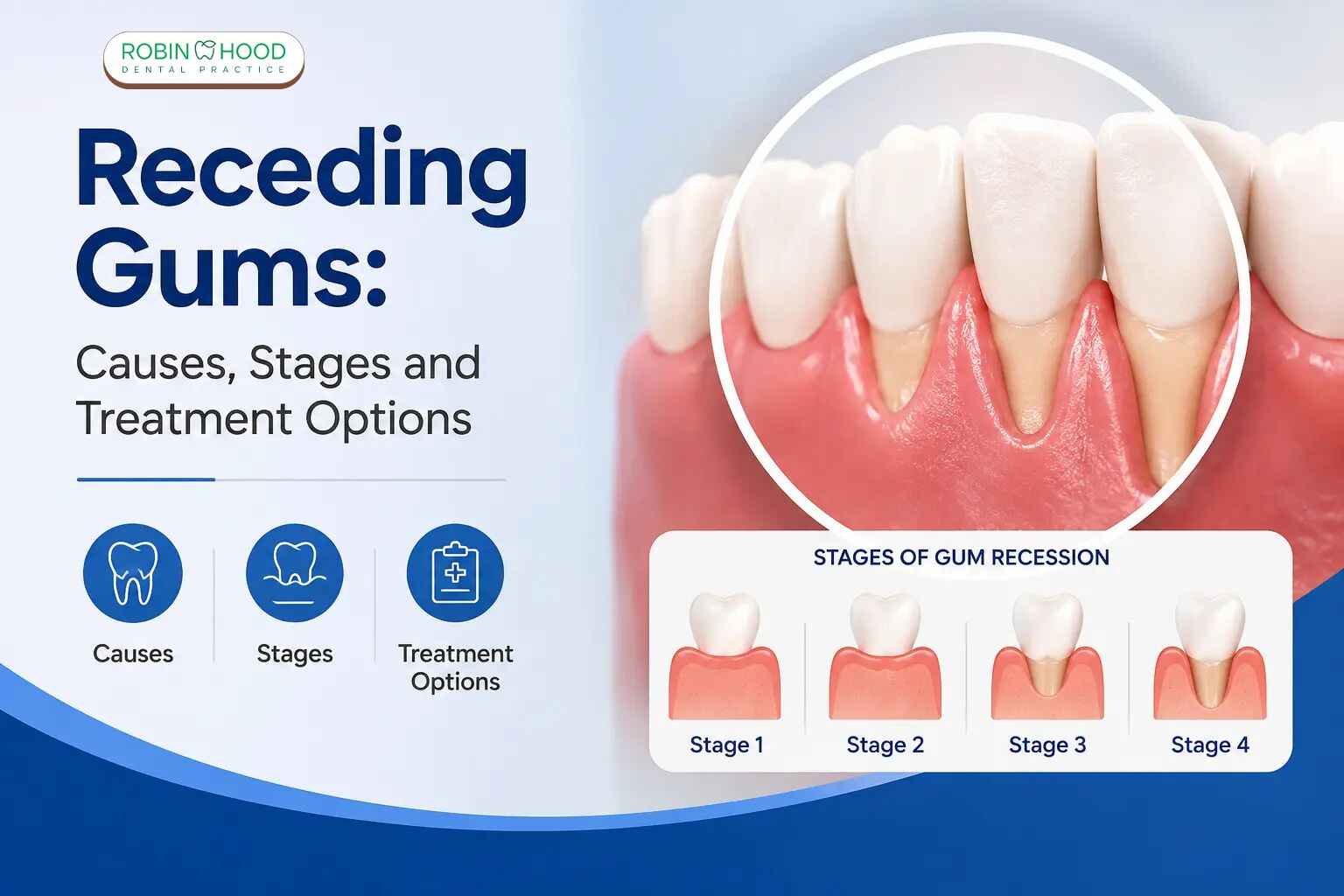 Why Are My Gums Receding? Causes, Stages and Treatment Options