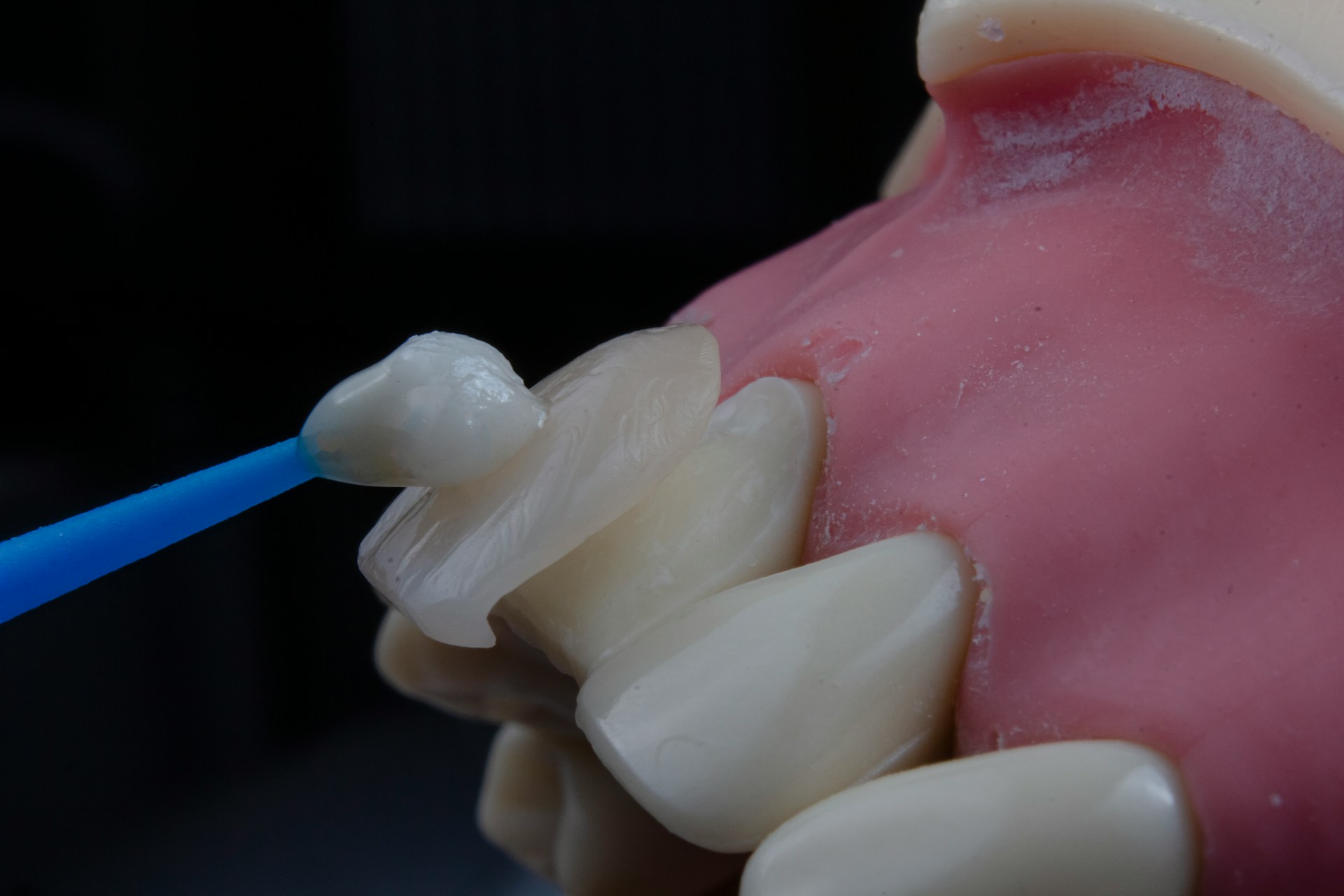 What Is a Dental Crown? Types, Benefits, Procedure, Cost and Aftercare