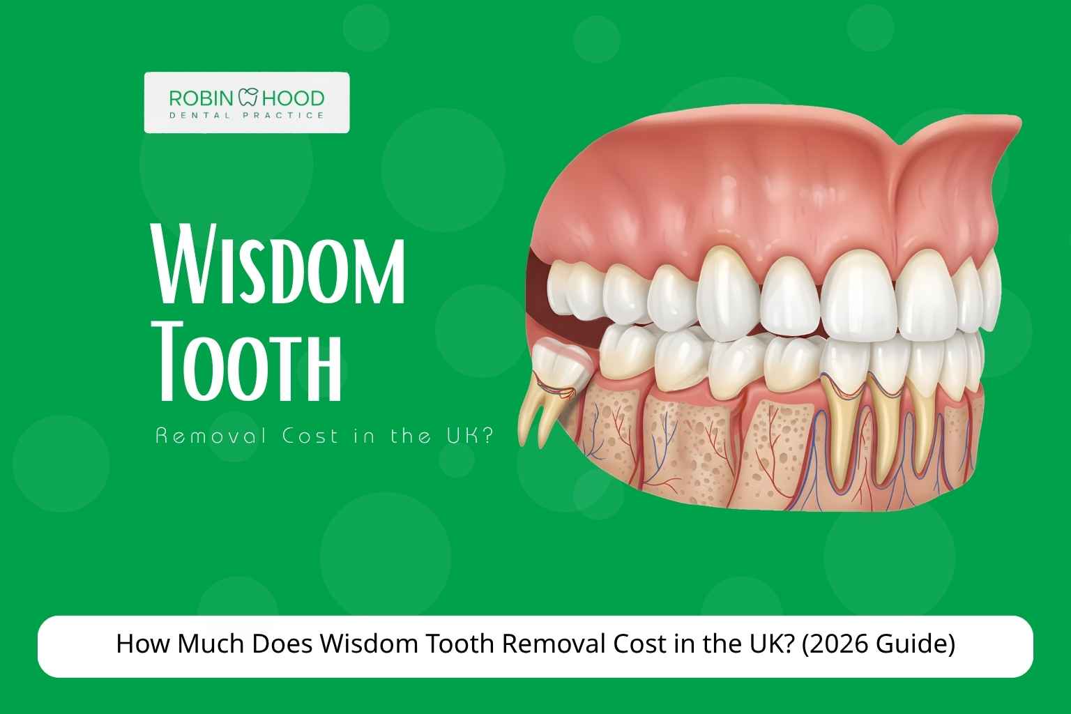 How Much Does Wisdom Tooth Removal Cost in the UK? (2026 Guide)