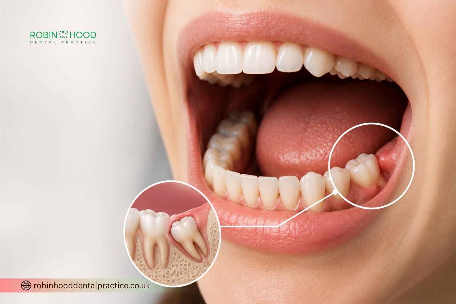 Wisdom tooth pain caused by limited space, showing a partially erupted wisdom tooth and gum irritation in the back of the mouth.