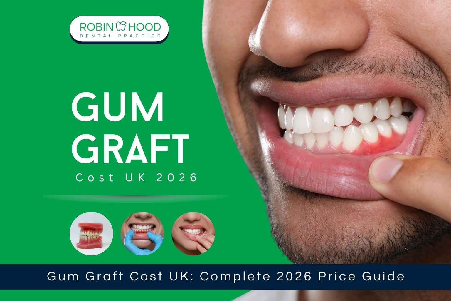 Gum Graft Cost UK: Complete 2026 Price Guide